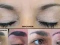 PMU entfernen: Was Sie über Laser, Remover & Kosten wissen müssen
