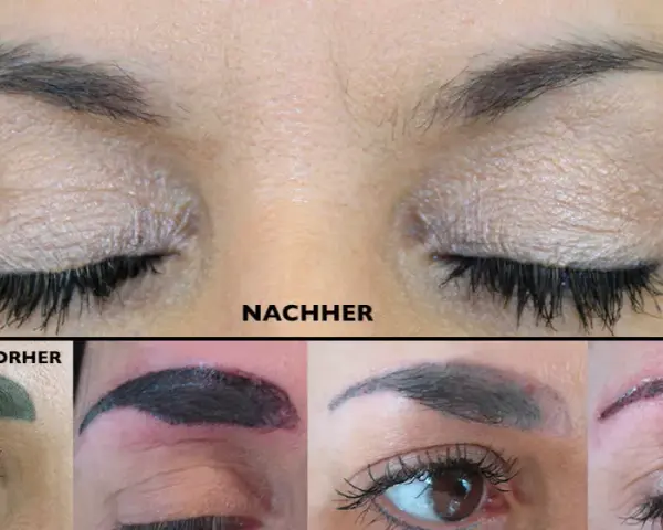 PMU entfernen: Was Sie über Laser, Remover & Kosten wissen müssen