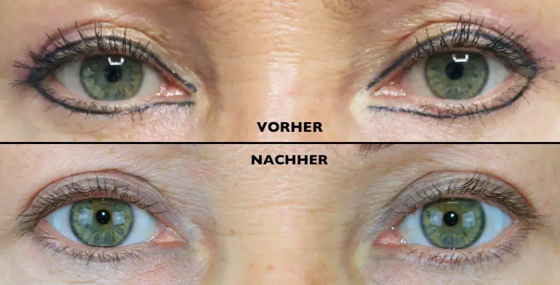 Zdjęcie PMU entfernen: Was Sie über Laser, Remover & Kosten wissen müssen
